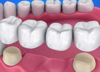 dental crowns and bridges